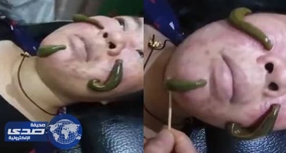 سيدة تستعين بالديدان لعلاج حب الشباب