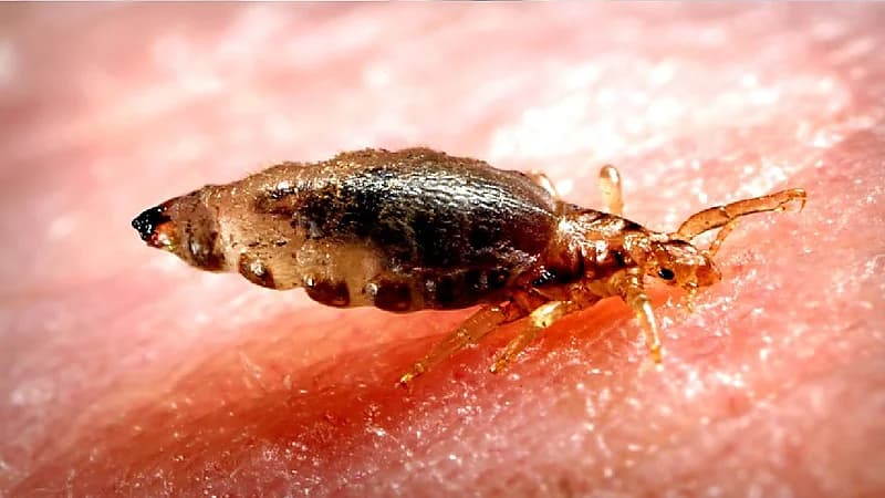 بالفيديو .. استشاري: القمل قد ينقل أمراض للجسم