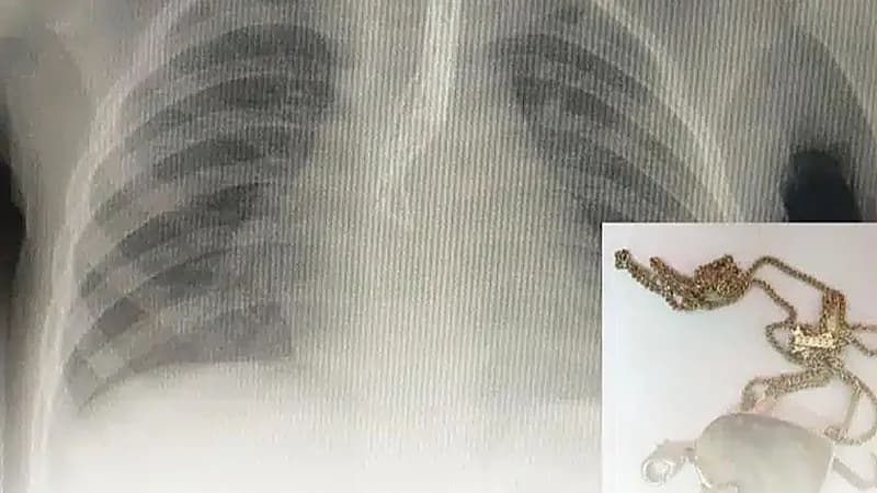 “الفرق الطبية“ تنجح في إنقاذ حياة طفلة ابتلعت “قلادة” بالمدينة المنورة