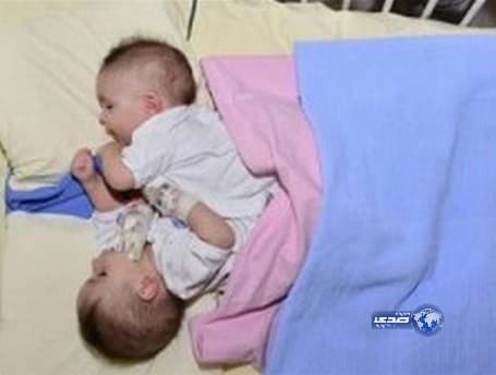 نجاح عملية فصل «السيامي» العراقي كريس وكريستيان