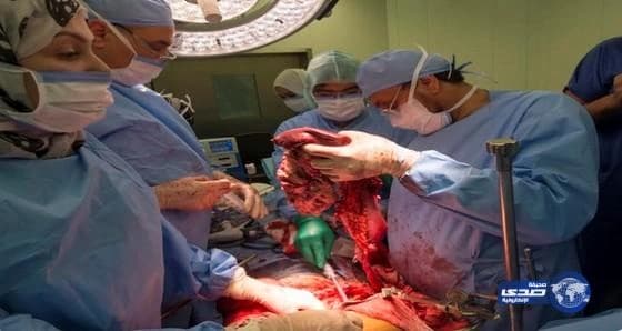 استئصال ورم نادر من بطن خمسيني بمدينة الملك عبد الله الطبية