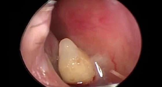 خلع سن في أنف سيدة صينية