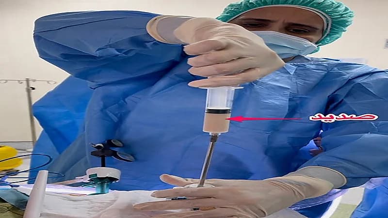 طبيبة تستعرض صديد هائل كاد أن يدمر حياة مريض