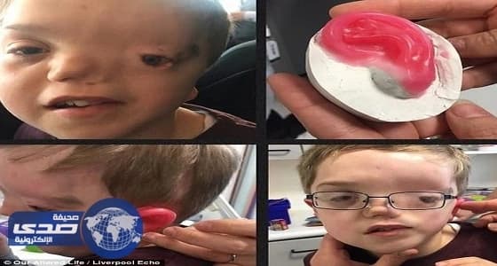 بالصور.. طفل بنصف وجه يشتهر بوحش الهالوين