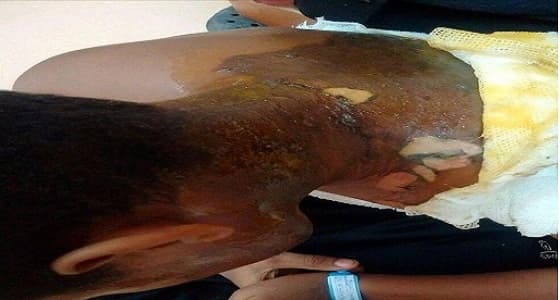 تفاصيل.. استدراج طفل وسكب مادة حارقة عليه أمام منزله بـ " العلا "