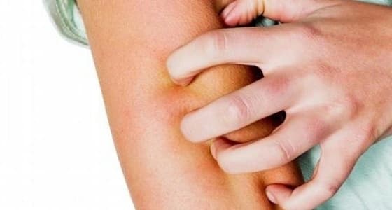 اشتباه في 3 حالات جرب في ابتدائية للبنات بمكة