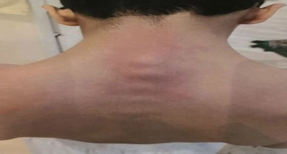 تعليم عسير يكشف حقيقة اعتداء معلم على طالب وتسببه في انزلاق فقراته