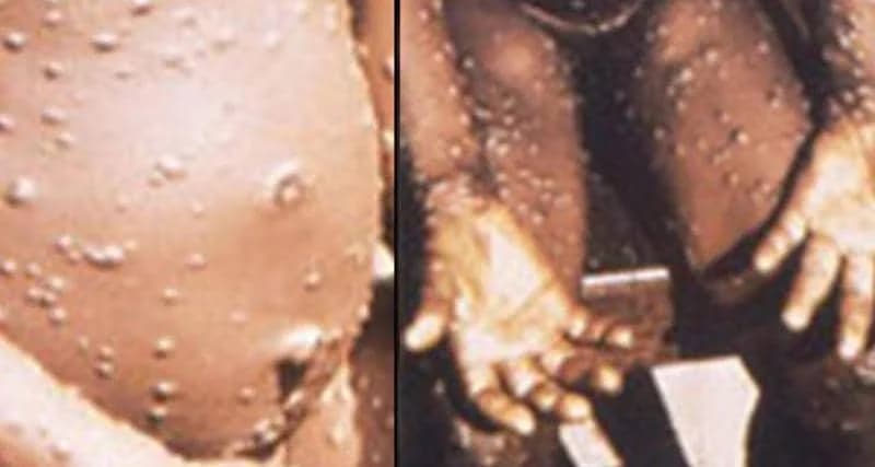 إكتشاف أول إصابة بجدري القردة النادر في تكساس