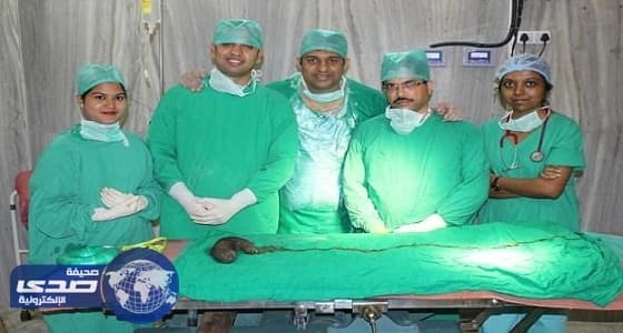 بالصور.. إزالة كتلة شعر ضخمة من معدة امرأة