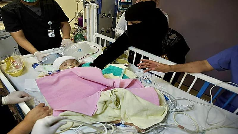 نجاح فصل التوأم السيامي اليمني «يوسف وياسين» في عملية استغرقت 15 ساعة