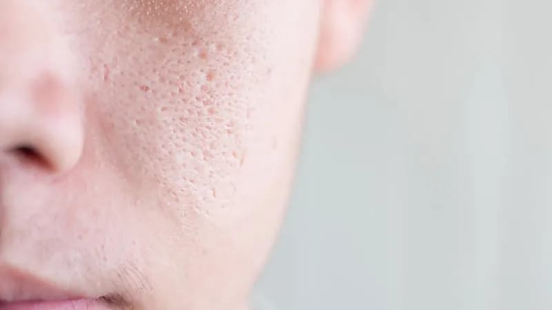 بالفيديو.. أسباب توسّع المسامات في البشرة وظهور الرؤوس السوداء