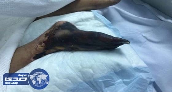 الإهمال الطبي في " الشميسي " يهدد قدم مواطنة بالبتر