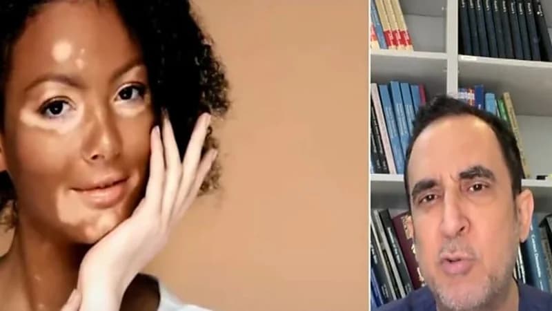 شاهد.. استشاري يكشف مدى فعالية علاج البهاق الجديد