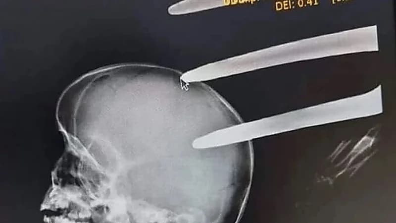 مصرع طفل بـ شوكة في الرأس أثناء لعبه