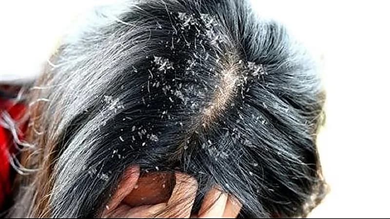 أبرزها السمنة والاكتئاب.. مشكلات صحية تسبب زيادة قشرة الرأس