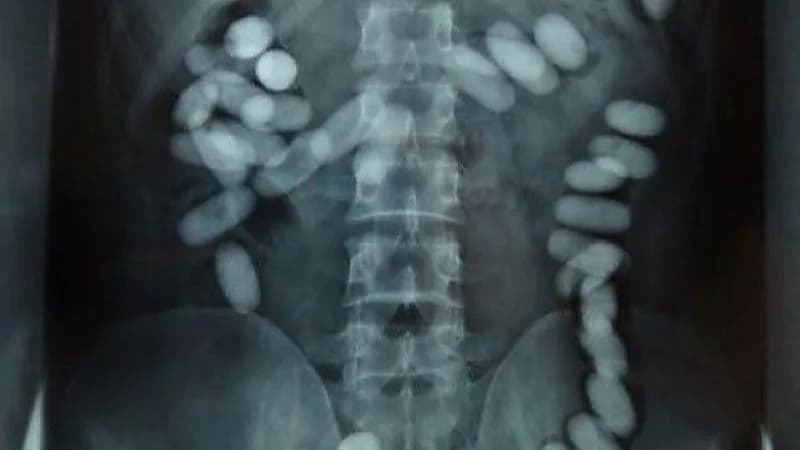 السجن 10 سنوات لآسيوي هرب مخدرات داخل أحشائه