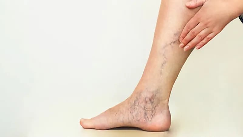 أسباب دوالي الساقين وطرق الوقاية