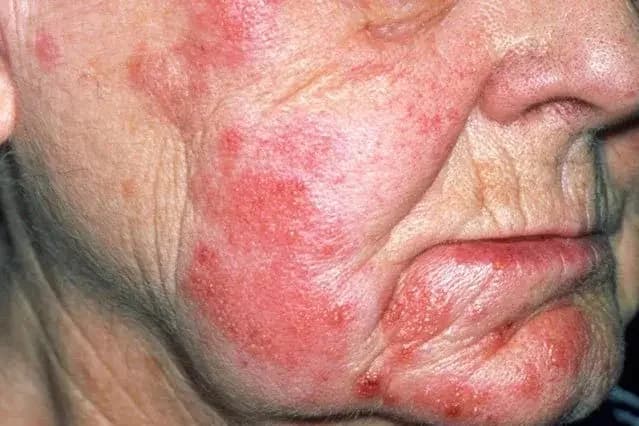 مناطق في الجسم معرضة للإصابة بالحزام الناري .. فيديو