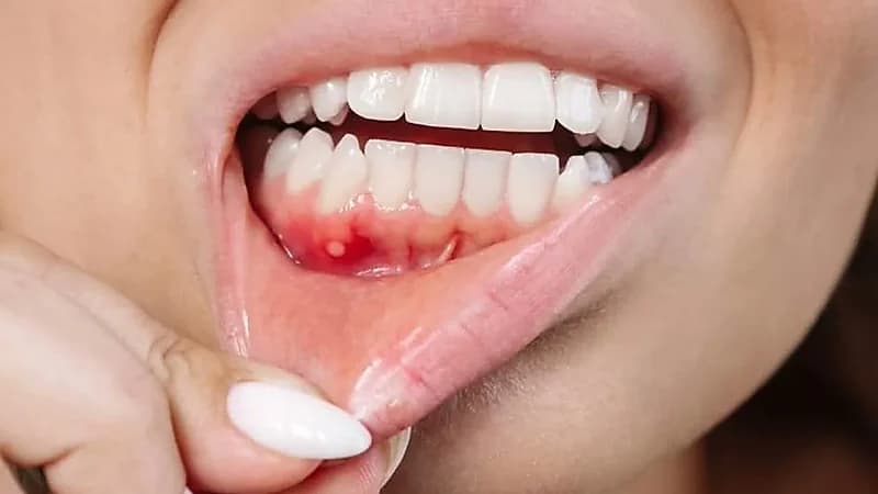 تحذير طبي: أعراض بسيطة قد تخفي أخطر أنواع سرطان الفم