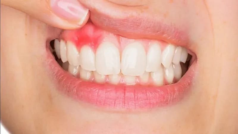 3 طرق منزلية سريعة لعلاج التهاب اللثة