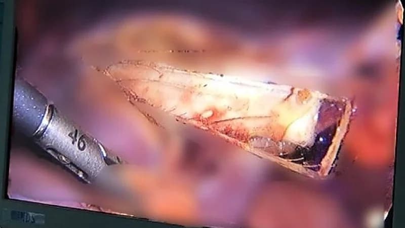 شخص يكتشف وجود شظية زجاجية في كبده منذ 9 سنوات .. صور