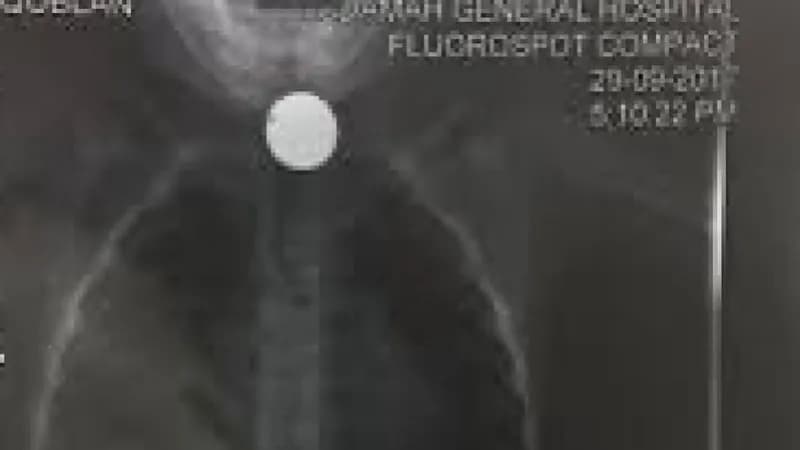 انقاذ حياة طفل ابتلع بطارية و14 قطعة لأجسام مختلفة توقفت بالمريء في نجران