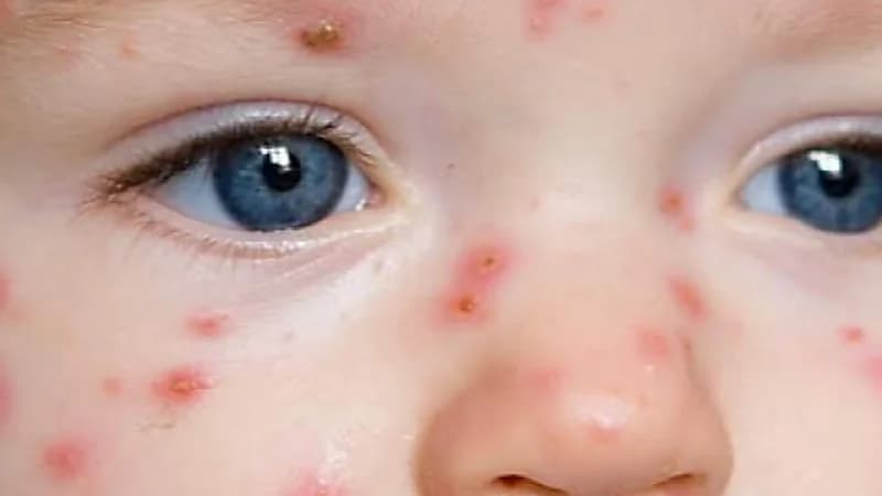 أسباب وأعراض مرض الشرى عند الأطفال