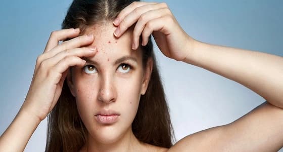 أسباب حب الشباب كثيرة وأبرزها التغيرات الهرمونية