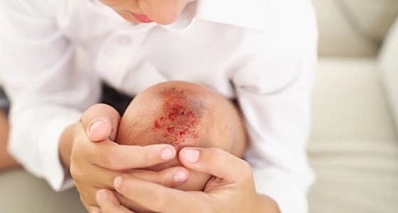 أسباب الجروح و نصائح مهمة لعلاجها في وقت قصير