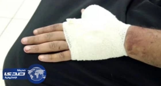 ‏" سعود الطبية " تحذر من الاستخدام الخاطئ للسكاكين والسواطير