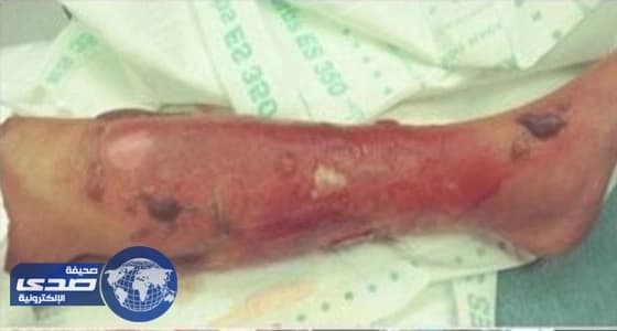 سيدة تُصارع الموت نتيجة بكتيريا قاتلة بالبحر