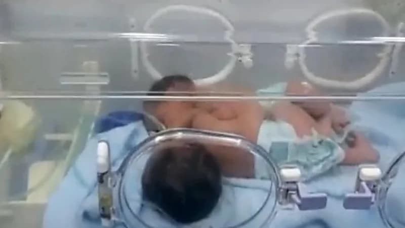 شاهد.. الصور الأولى للتوأم السيامي اليمني "مودة ورحمة "