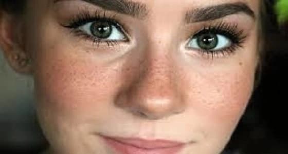 طرق سهلة للتخلص من مشكلة النمش