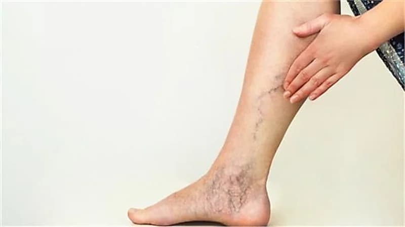 أسباب انسداد شرايين الساق وطرق علاجها