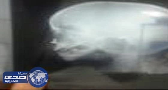 استخراج مسمار من أنف طفلة بمستشفى الأسياح