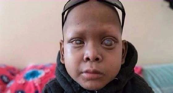بالفيديو :حالة نادرة. .طفل يذرف دماً بدل الدموع