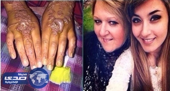 بالصور.. تشوهات نتيجة استخدم حناء سوداء بالمغرب