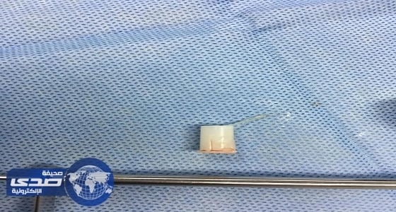 إجراء عملية ناجحة لطفل ابتلع " صفارة " واستقرت في القصبة الهوائية