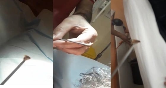 بالفيديو.. طوارئ " أضم العام " تنجح في استخراج " حشرة " من أذن طفلة