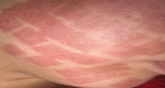 شاهد.. تشوه وجه عروس في مركز تجميل قبل زفافها