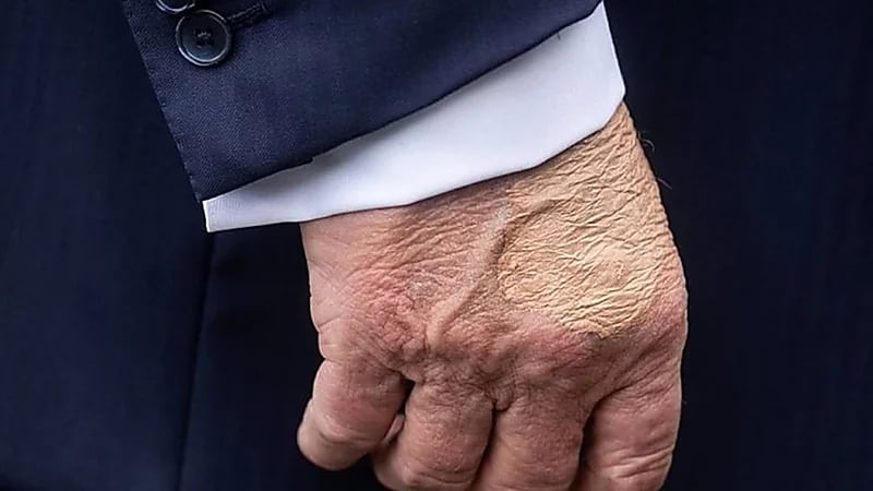 كدمة غامضة على يد ترامب تثير التساؤلات والبيت الأبيض يوضح الأسباب .. فيديو وصور