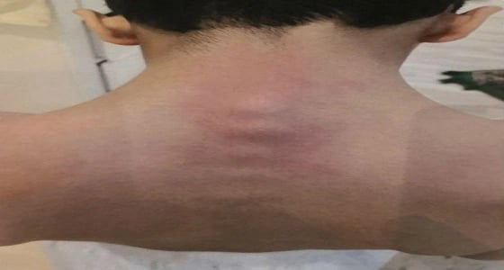 تعليم عسير يكشف حقيقة اعتداء معلم على طالب وتسببه في انزلاق فقراته