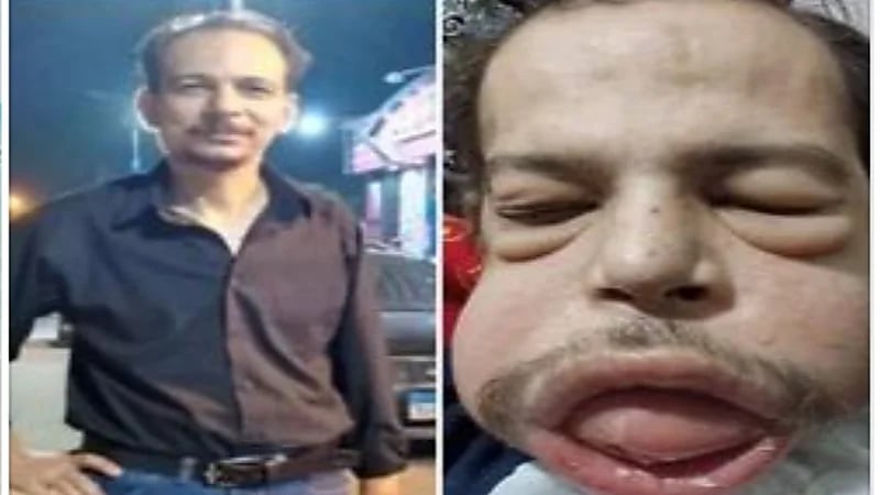 خطأ طبي يصيب مصري بمرض نادر يمنعه من الأكل طوال حياته