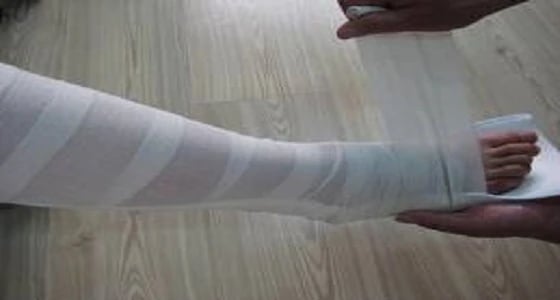 التحقيق في واقعة وضع جبيرة بشكل خاطئ كادت تبتر قدم مريض