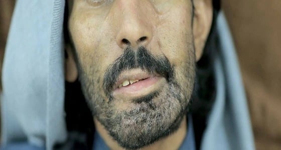 مريض يفقد النطق والقدرة على الطعام بسبب " إهمال طبي "
