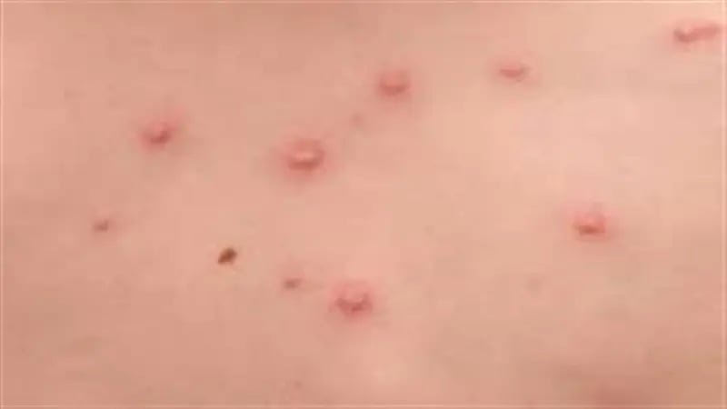 رصد إصابة جديدة بجدري القرود في مصر