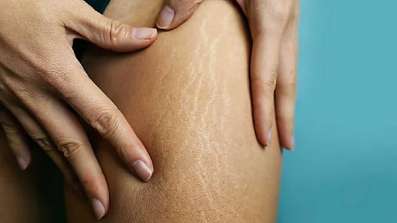 فوائد غير متوقعة لـ "السيلوليت" !