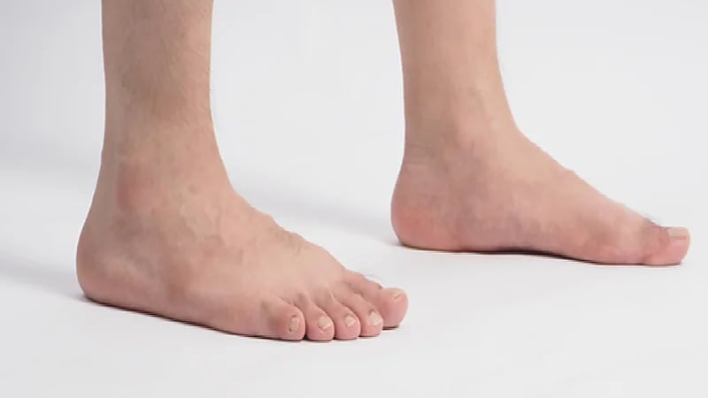 بالفيديو.. استشاري قدم وكاحل: مليون مواطن مهدد بالبتر في المملكة