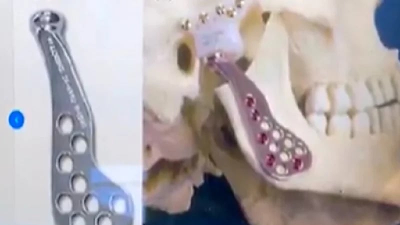 بالفيديو.. فريق طبي بالخبر ينجح في إزالة التحام حاد بين الجمجمة والفك لمريضة