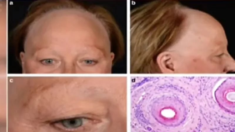 "استشاري" يوضح طرق علاج الصلع الوراثي